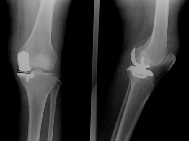 【典型案例】左膝关节疼痛单髁置换术治疗