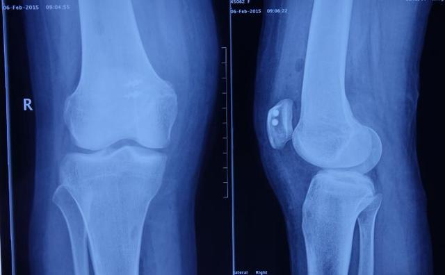 【典型案例】髌骨脱位的右膝关节镜下关节腔探查+内侧髌骨韧带重建术治疗