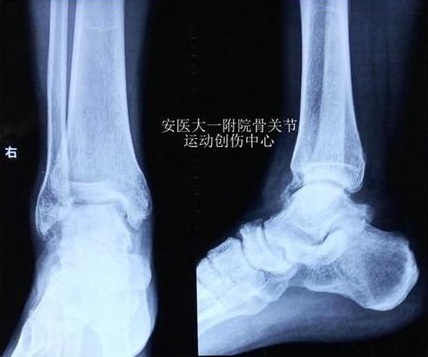【典型案例】踝关节前方撞击症的关节镜下治疗