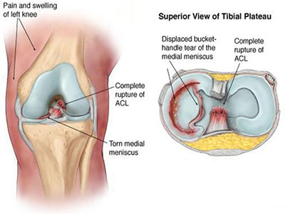 膝关节盘状半月板损伤与治疗