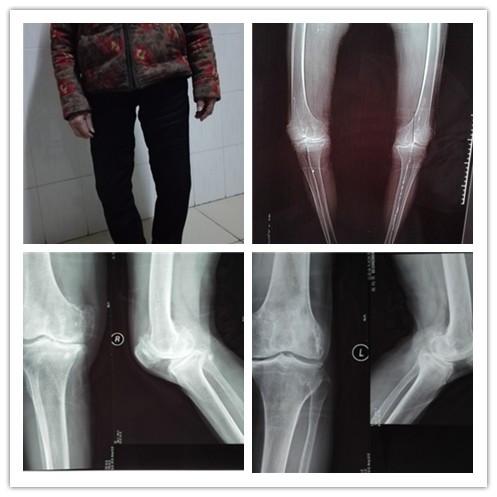 【典型案例】一期双侧膝关节表面置换术一例